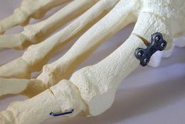 Open wedge Osteotomie MT1