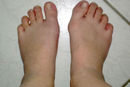Der juvenile Spreizfuß mit Hallux valgus