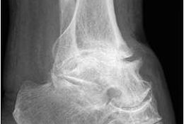 Die pantalare Arthrodese mittels retrogradem Arthrodesenagel