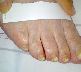 Schwere Nagelpilzerkrankung