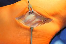 Operative Therapie der Peronealsehnenluxation und Peronealsehneninstabilität