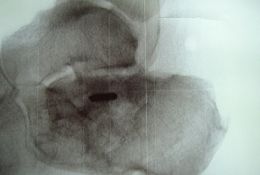 Dorsale Arthroskopie des oberen und unteren Sprunggelenks