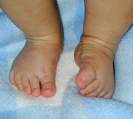 Leichte und flexible Fehlstellungen sind bei Kinderfüßen nicht selten und lassen sich meist durch Physiotherapie gut behandeln