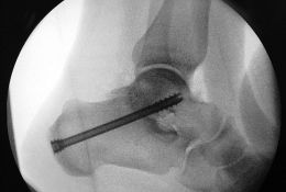 Subtalare Arthrodese