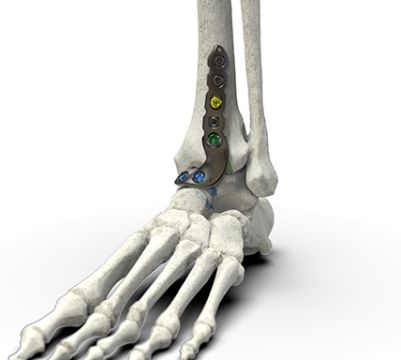 axomed - Ankle Fusion System
