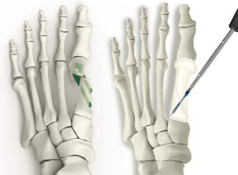 axomed - TWIN MIS Minimalinvasives Basisosteotomie-System