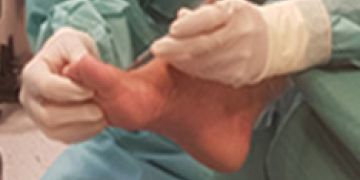 Linkshändige Operateure - Spezielle Aspekte der minimalinvasiven Chirurgie
