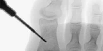 Minimalinvasive Akin Osteotomie