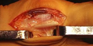 Abbildung 12: Als nächster Schritt erfolgt die dorsale Osteotomie.  Zu beachten ist, dass keine Hebelkräfte aufgewendet werden. Auch hier wird die Osteotomie mit dem Bildverstärker kontrolliert.