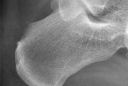 Endoskopische Therapie der Haglunddeformität