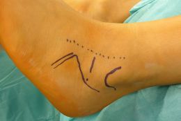Die subtalare Arthrorise beim symptomatischen und flexiblen kindlichen Knick-Plattfuß mit Sinus-Tarsi Spacer