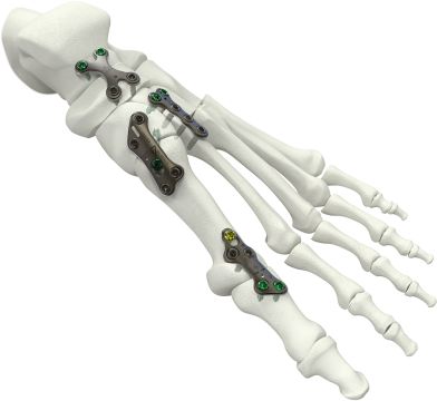 axomed - Innovative Platten für Frakturen, Osteotomien und Arthrodesen