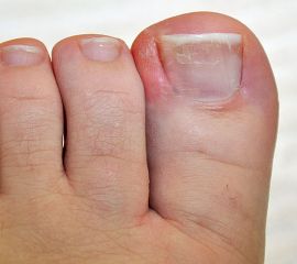 Eingewachsener Zehennagel mit Entzündung des Nagelbetts