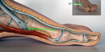 Abbildung 12: Als nächster Schritt erfolgt die dorsale Osteotomie.  Zu beachten ist, dass keine Hebelkräfte aufgewendet werden. Auch hier wird die Osteotomie mit dem Bildverstärker kontrolliert.