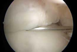 Ventrale Arthroskopie des oberen Sprunggelenks