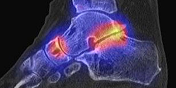 SPECT/CT ind der Fuss- und Sprunggelenkschirurgie