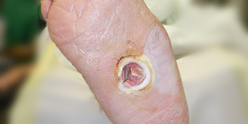 Minimalinvasiv-operative Therapie mechanisch bedingter Ulcera beim diabetischen Fußsyndrom