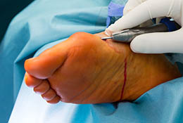 Prinzipien der Minimalinvasiven Fußchirurgie