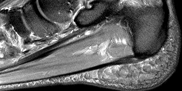 Plantarfasziitis