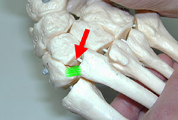 Lisfranc-Ligament und Lisfranc-Luxationen