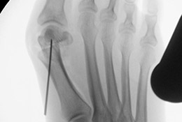 Hallux valgus: subkapitale Korrekturosteotomien