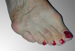 Kleinzehendeformitäten mit Bunionettedeformität