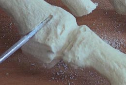 Isham Osteotomie
