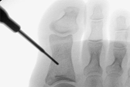Minimalinvasive Akin Osteotomie