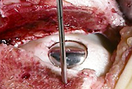 Die Verwendung eines lokalen metallischen Oberflächenersatzes (HemiCAP®) in der Behandlung osteochondraler Läsionen am Talus