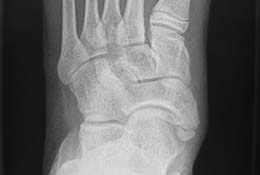 Os tibiale externum und Os naviculare cornutum