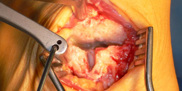 Die Arthrose des TMT II und III Gelenks bei Spreizfuss