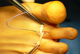 Der Transfer der langen Beugesehnen des M. flexor digitorum longus von plantar nach dorsal nach Girdlestone – Taylor