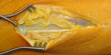 Das Kompressionsyndrom des Nervus peroneus superficialis am Unterschenkel