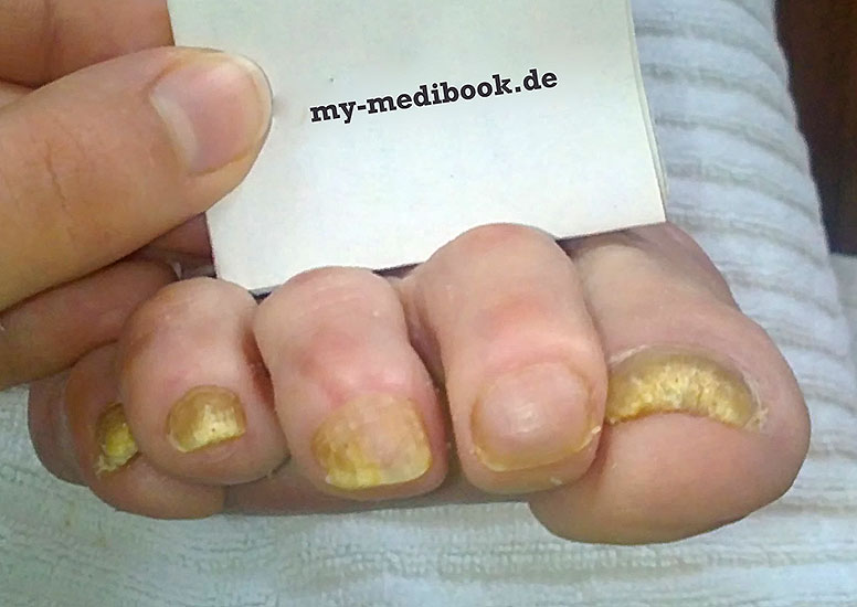 Nagelpilz Podologe Oder Hautarzt